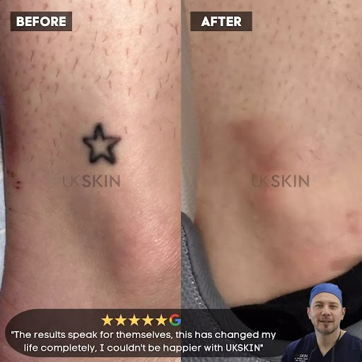 Sur 13 Tattoos: Is It Possible to Remove Them Safely?